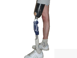 Diz Üstü Uzuv Kaybı