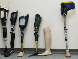 Amputasyondan Sonra Ne Zaman Protez Takabilirim